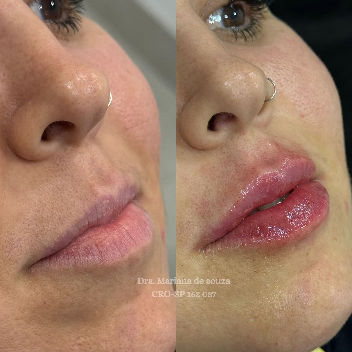 Comparativo de diagnóstico e conclusão de preenchimento labial